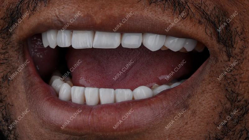 Final 20 Veneers